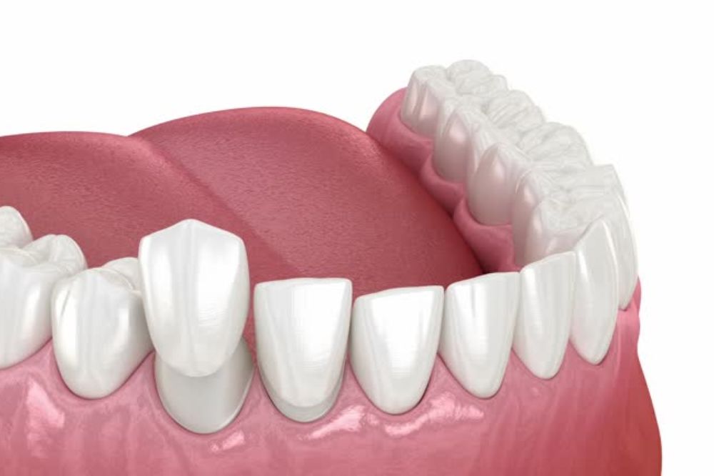 tooth bonding